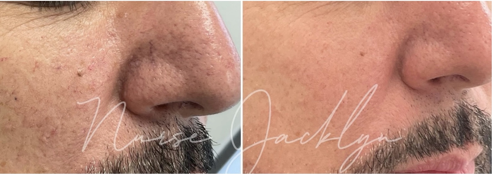 BBL before-and-after photo showing improvement in nasal-area visible vessels and cheek redness