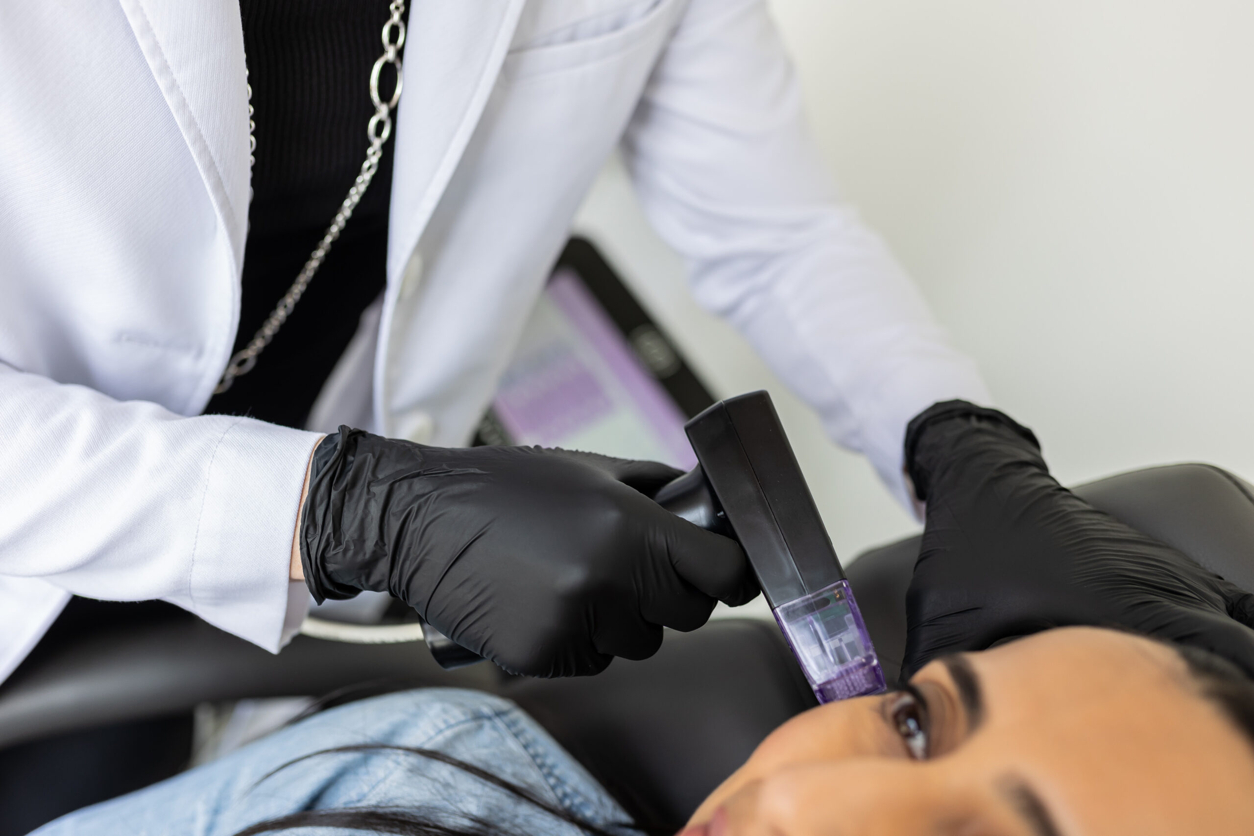 Morpheus8 RF microneedling treatment on the face at Distinct Medical Aesthetics