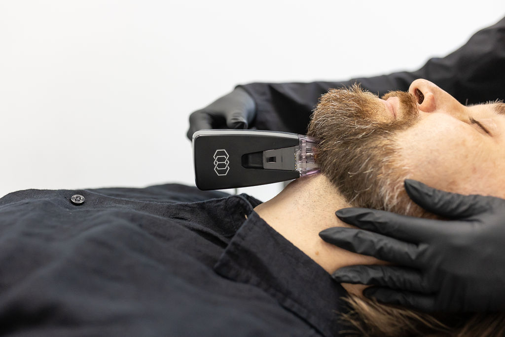 Morpheus8 RF microneedling treatment for the neck and jawline at Distinct Medical Aesthetics